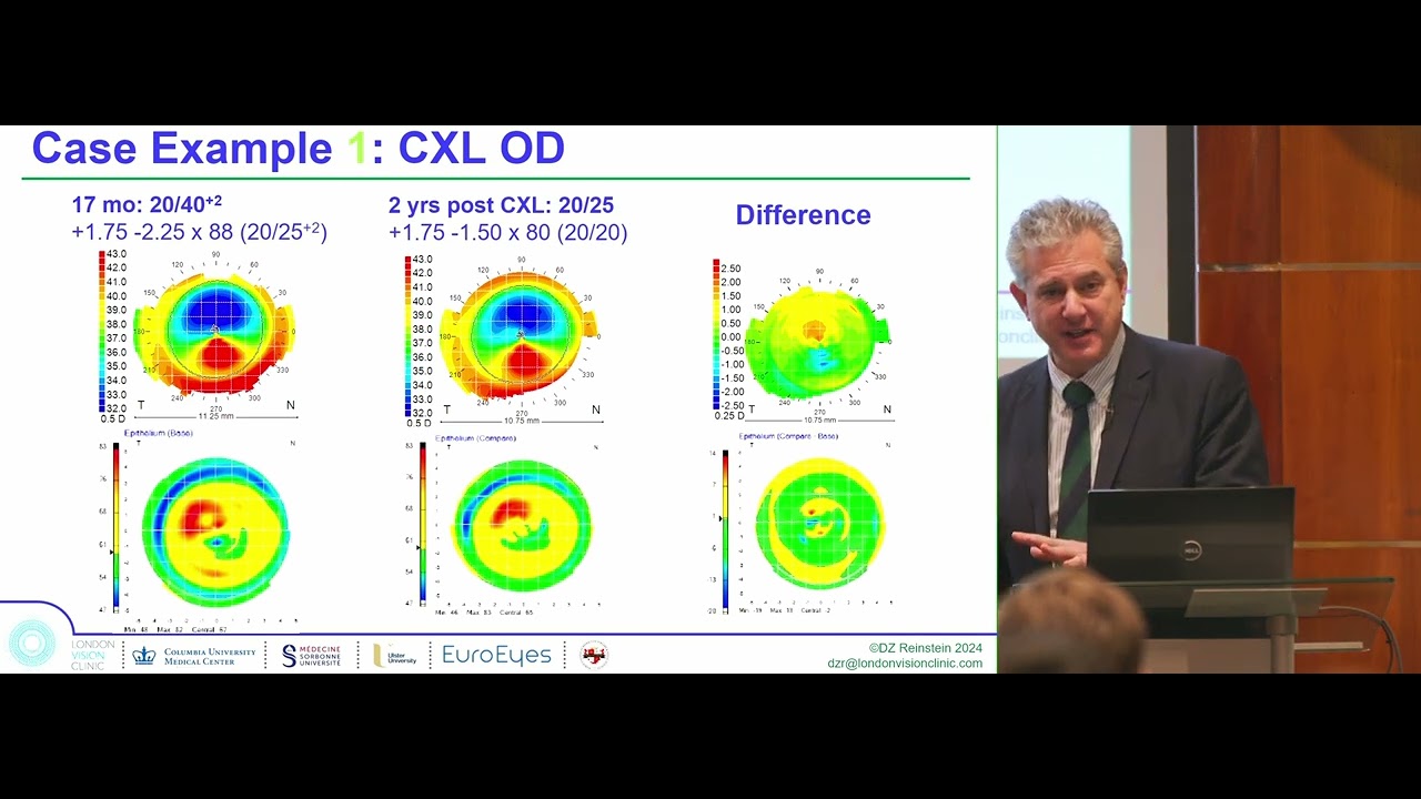 Ectasia Treatment CXL, TE PTK, topography guided treatment, intracorneal ring segments - Reinstein