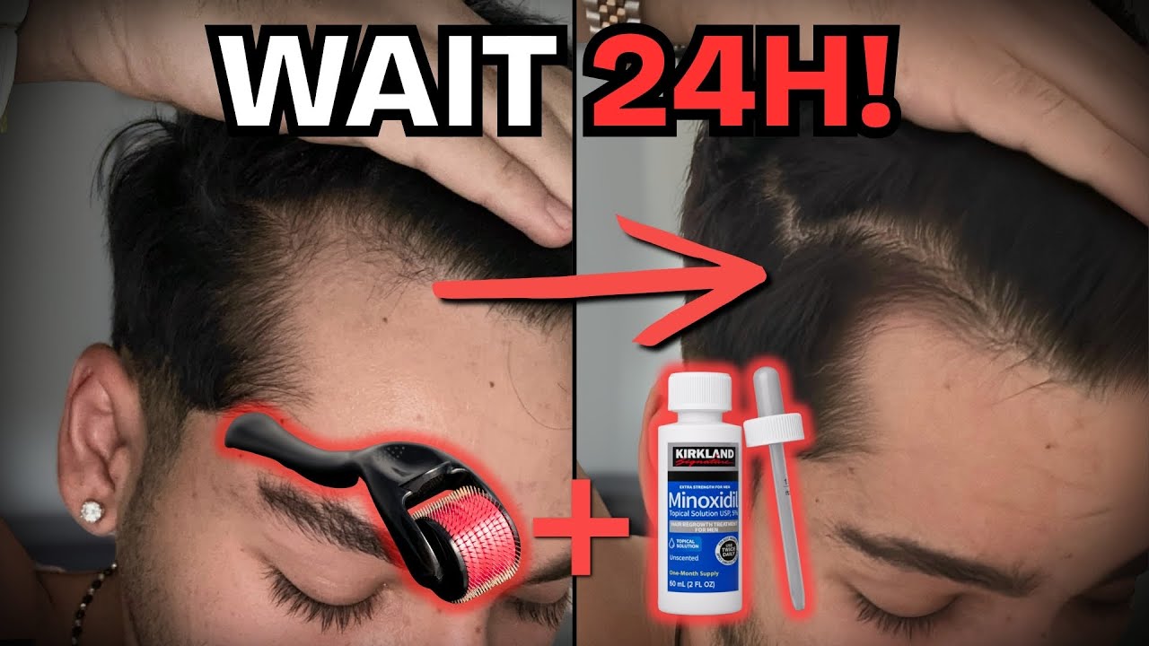 Minoxidil After Dermarolling for Hair Regrowth: How Long Should You Wait?