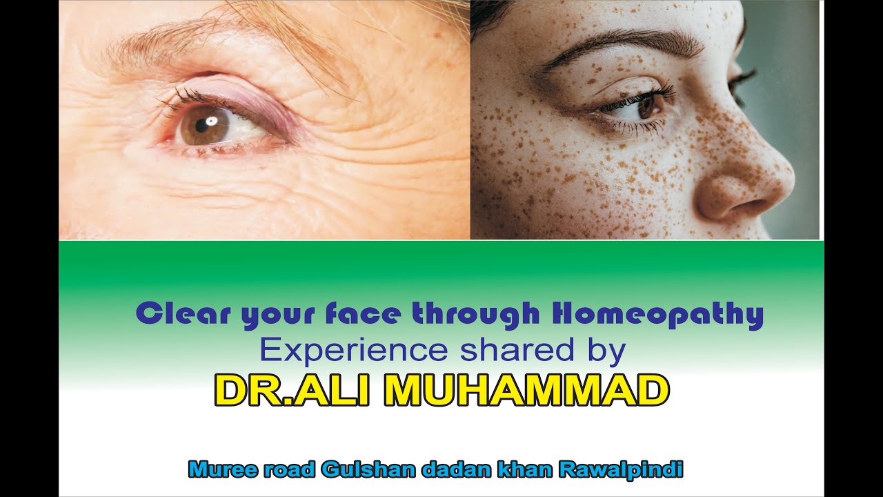 Remove your Freckles | Wrinkles | Pigmentation through homeopathy Experience by Dr Ali Muhammad