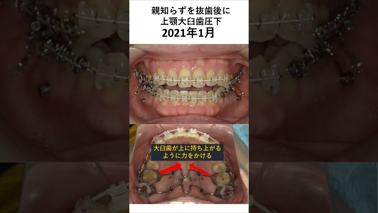 開咬の治療例 #歯医者　#矯正歯科  #braces