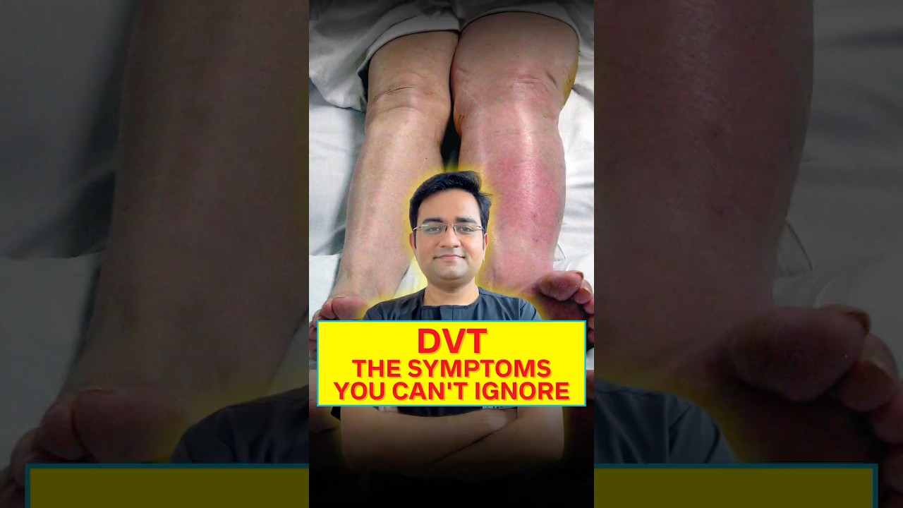 Deep Vein Thrombosis (DVT) in Simple Words | Blood Clot Risk Explained
