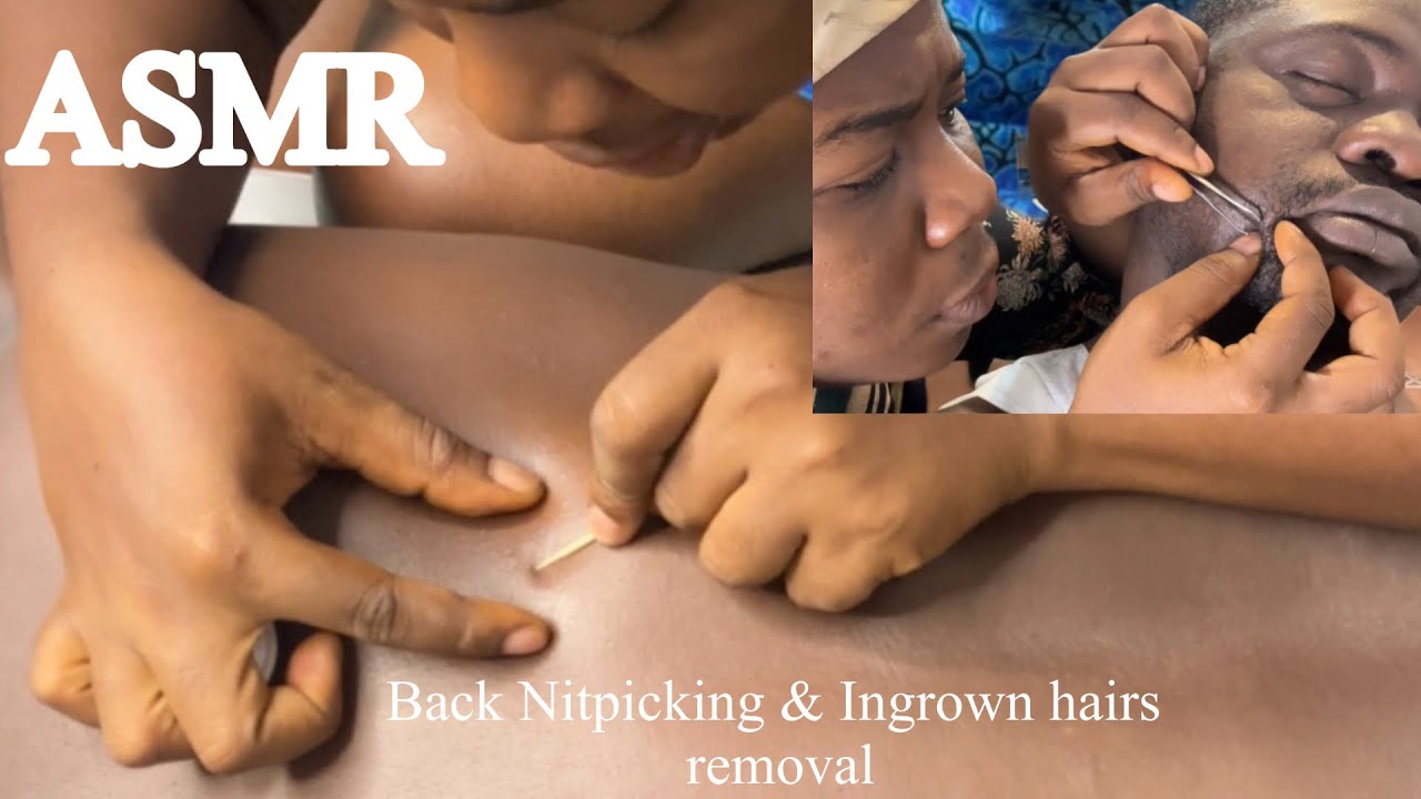 Asmr✨Satisfyingly Back Nitpicking and Ingrown Hairs Removal