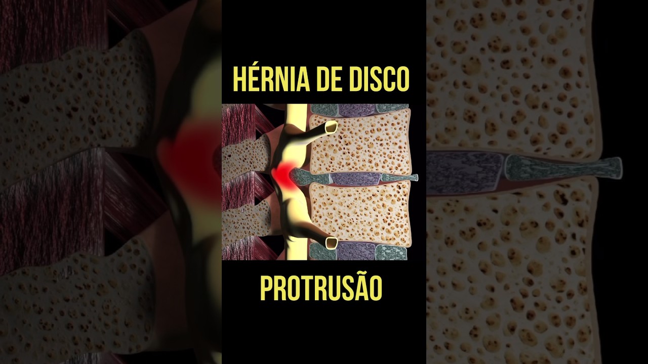 H&Eacute;RNIA DE DISCO (Protrus&atilde;o Discal)