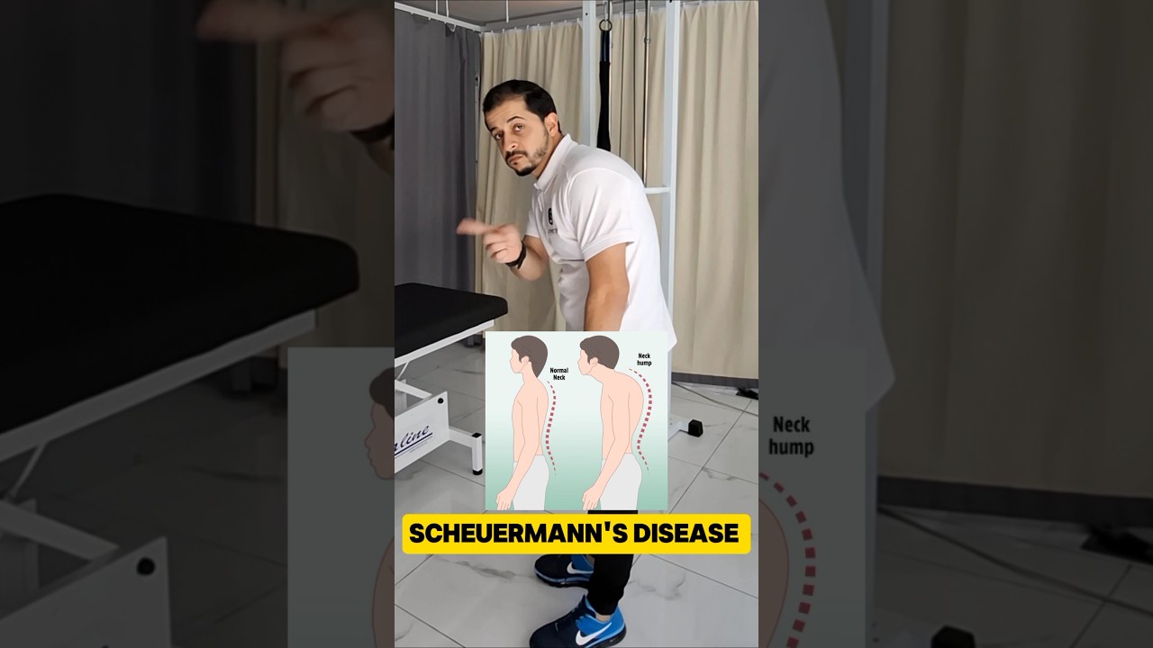 Best exercise to treat scheuermann's disease #shorts #youtubeshorts #dubai #physiotherapist #home