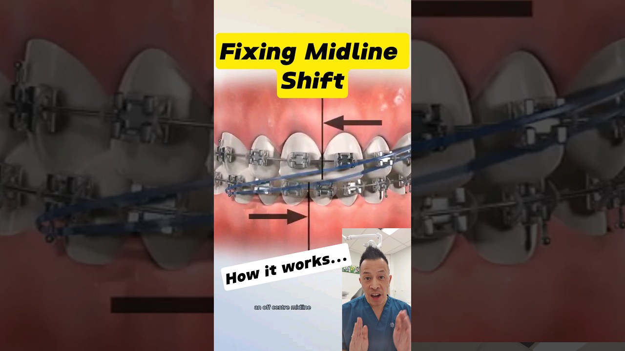 Magic of Elastics: Fixing Midline Shifts with Elastics! #dentallan #dentist #shorts