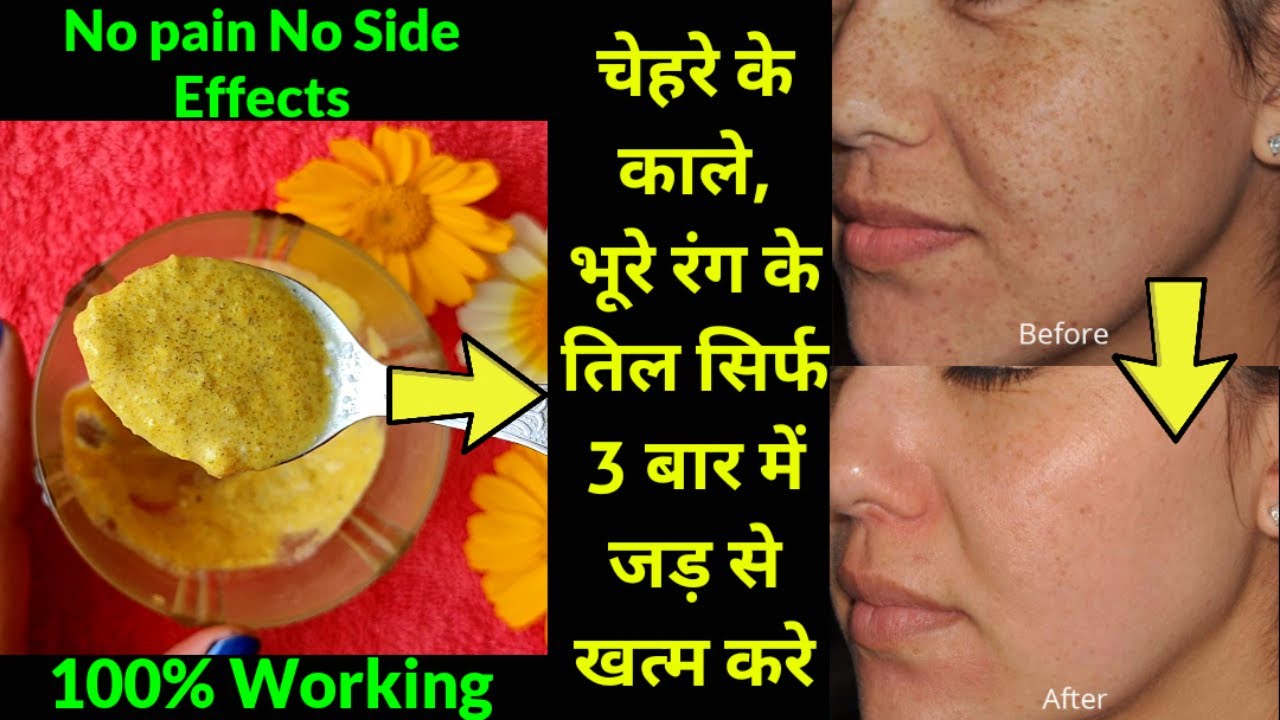 Remove Brown/Black Moles & Get Freckles Free Face, Simple Home Remedy | काले तील सिर्फ 3 बार में ख़तम