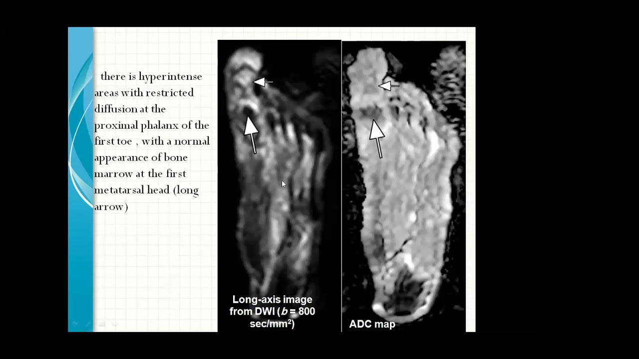 Diabetic foot  MRI examination