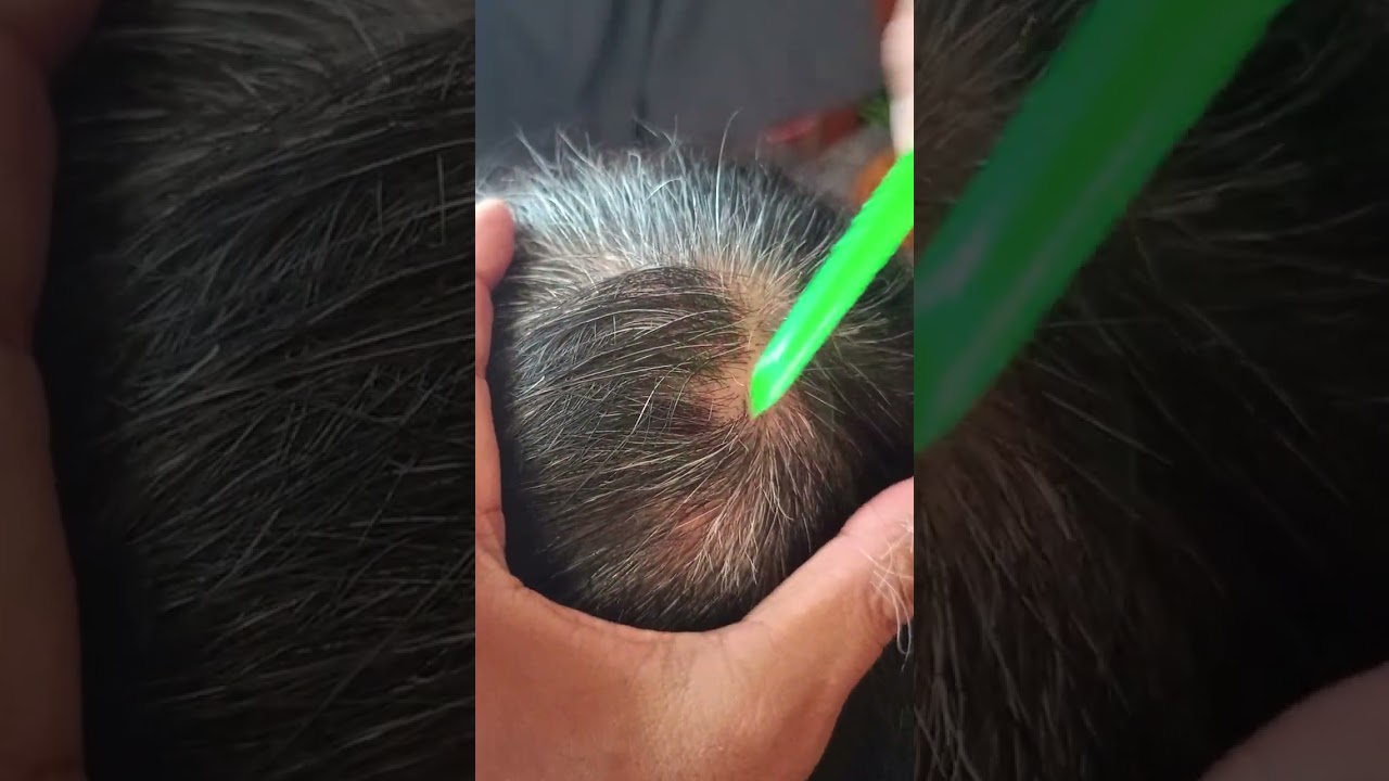 Most satisfying white hair removal 1.07#satisfying #relaxing #stressremoval