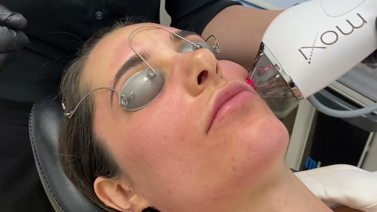 Moxi Laser Skin Resurfacing Treatment. Great Results, Little Downtime! - Utah Facial Plastics