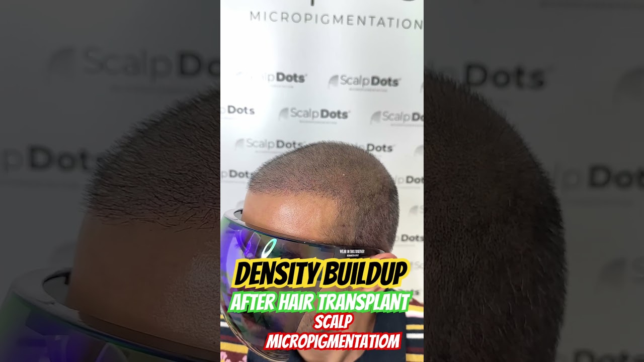 Density filling with scalp micropigmentation after hair transplant #smp #scalpmicropigmentation