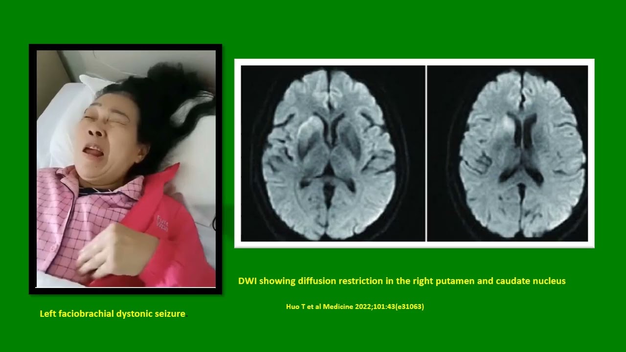Neurology Quiz #109 Autoimmune encephalitis (Part 1 of 2)