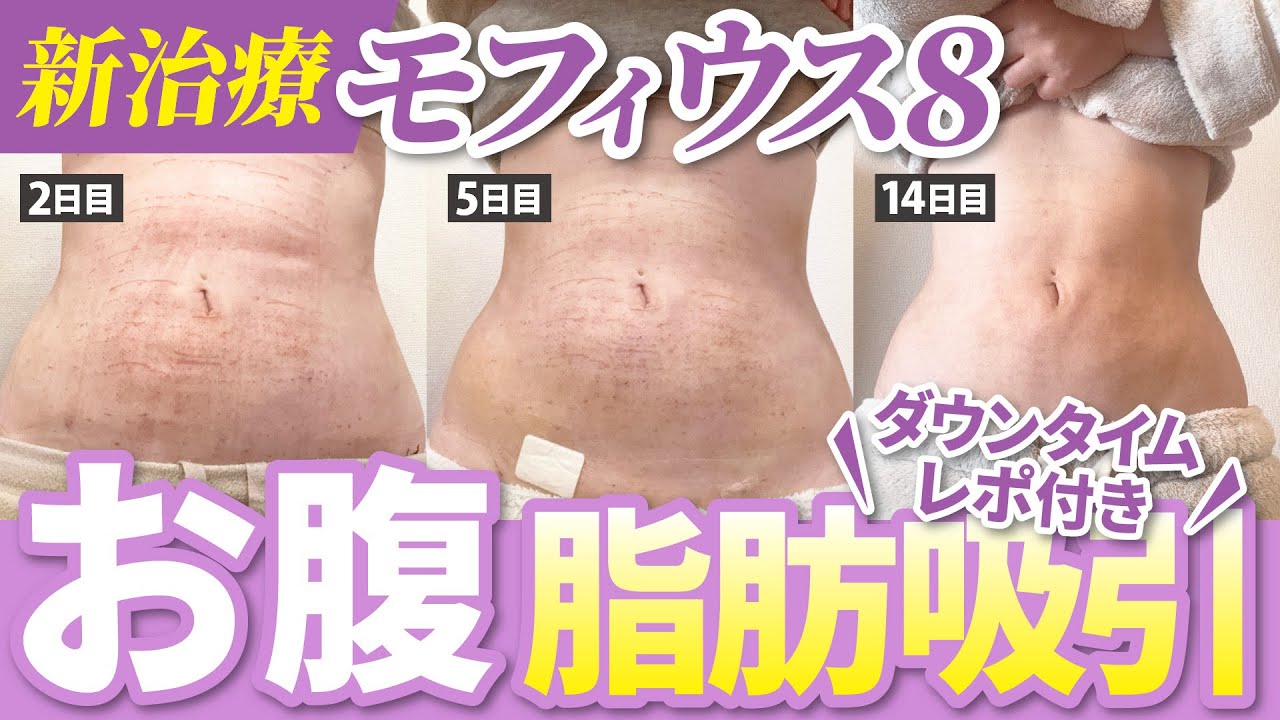 【ダウンタイムレポ付き】新治療モフィウス8ボディ受けてみた【お腹の脂肪吸引】