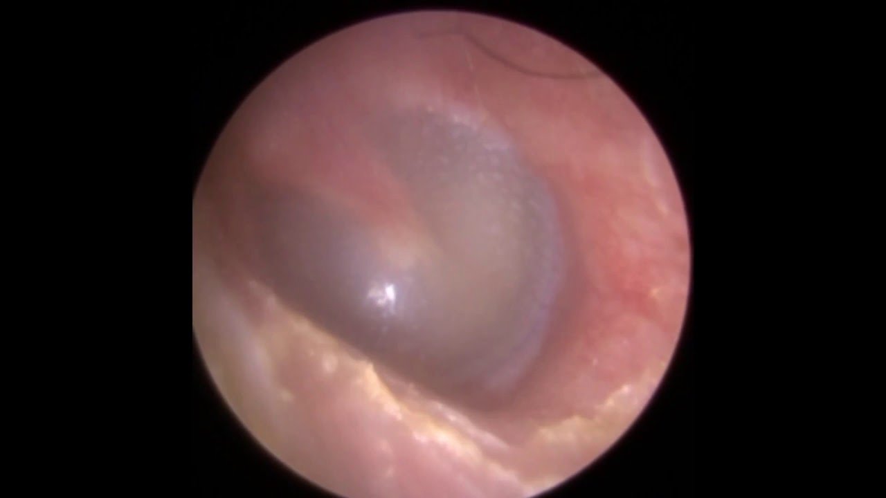 Ear Wax Removal Leicester - The Hear Clinic