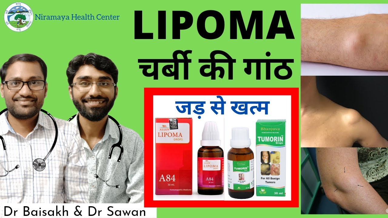 Homeopathic medicine for lipoma- charbi ki ganth ka ilaj / lipoma homeopathic medicine