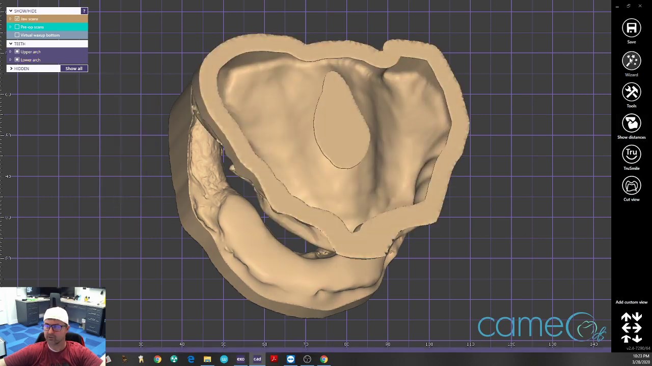 Exocad - (Live) Design of a Conversion Prosthesis for Immediate Load (All-on-X)