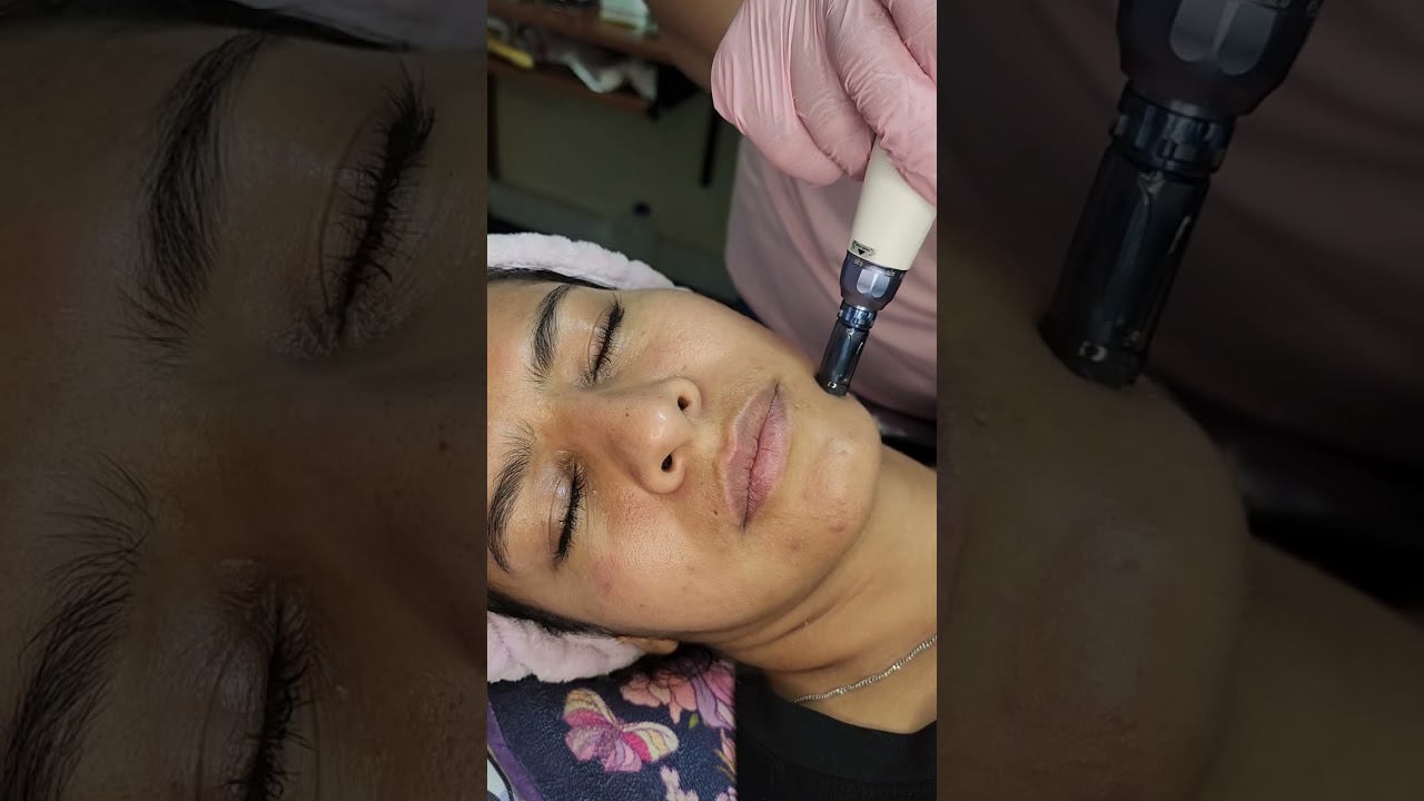 Microneedling-Dermapen. Curso Gratis 2026. Ayúdame a crecer y poder subir mas videos de mis clases.
