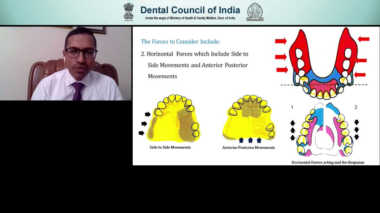 DCI Webinar 26 - Principles and Designing of Cast Partial Dentures