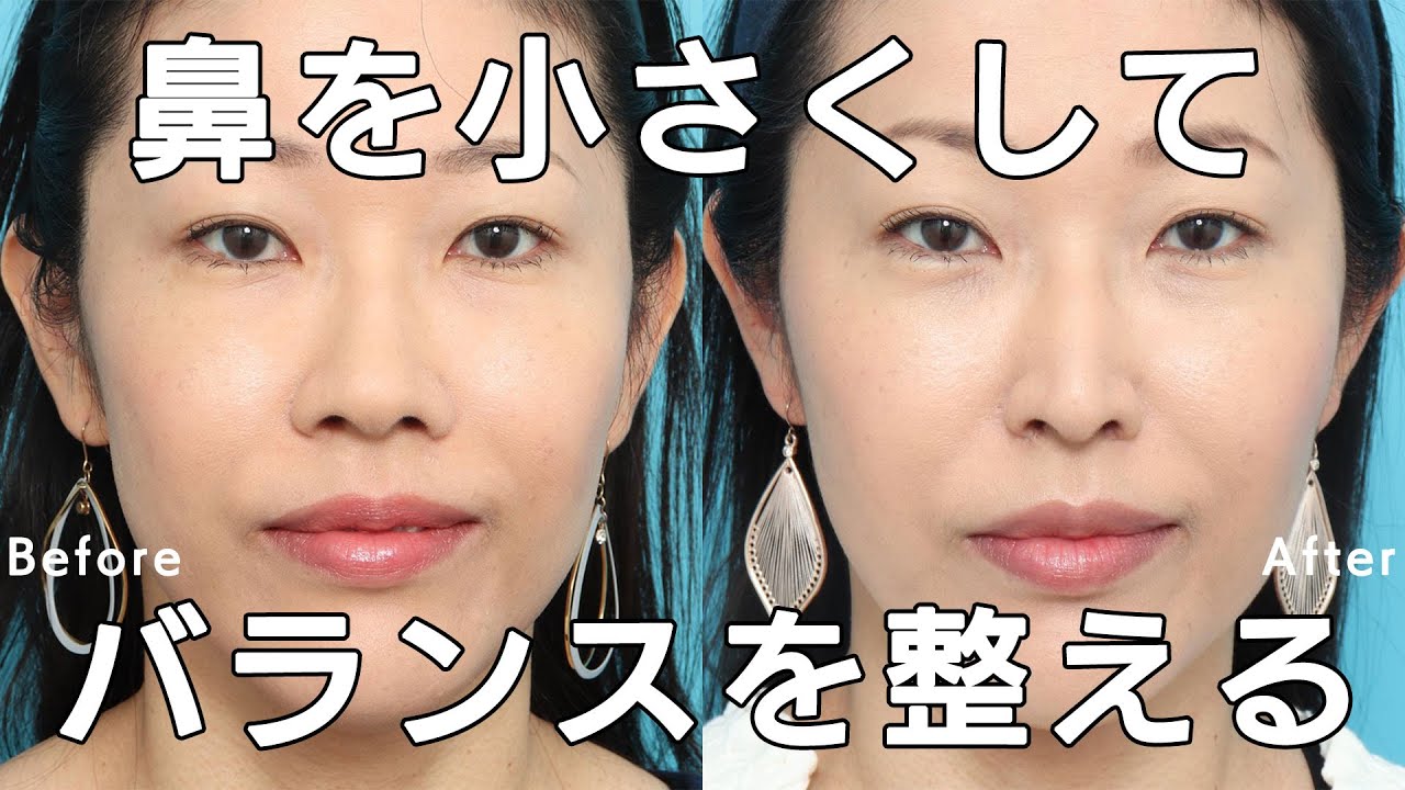 【鼻を小さくしたい】ヴェリテの鼻翼縮小術｜ヴェリテクリニック