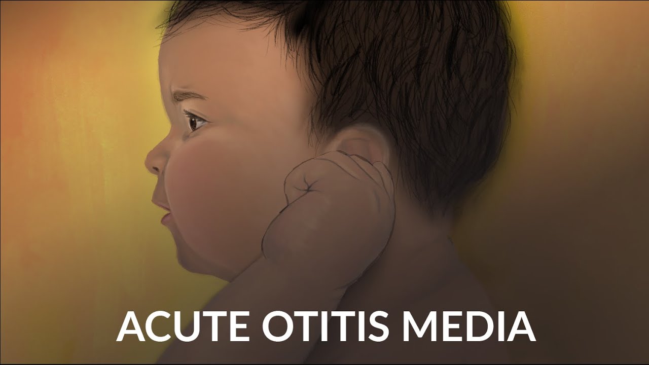 Острый средний отит (авторы: А. Руан, Дж. Ченг) | OPENPediatrics