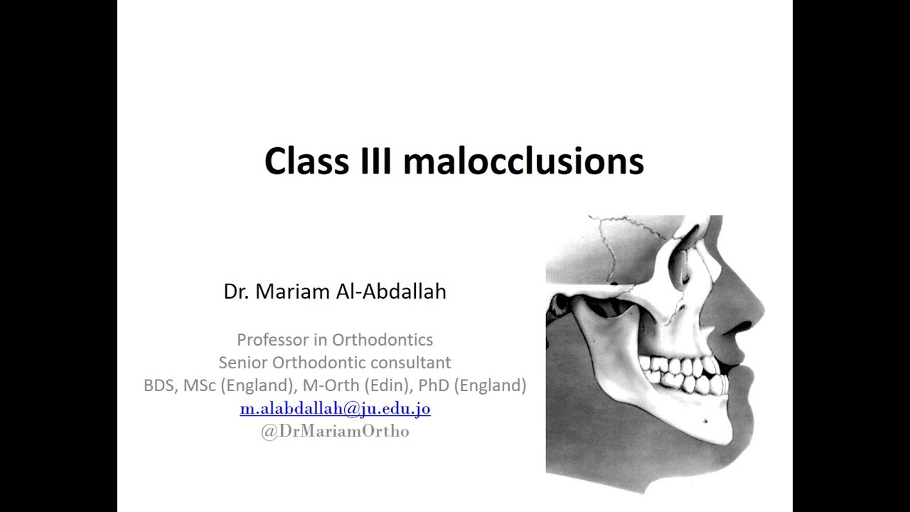 Dr. Mariam Class III malocclusions (1)