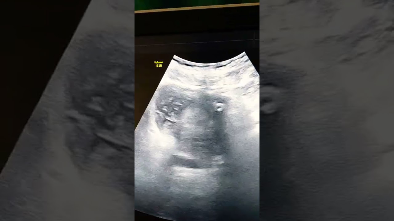 urinary bladder haematoma with BPH