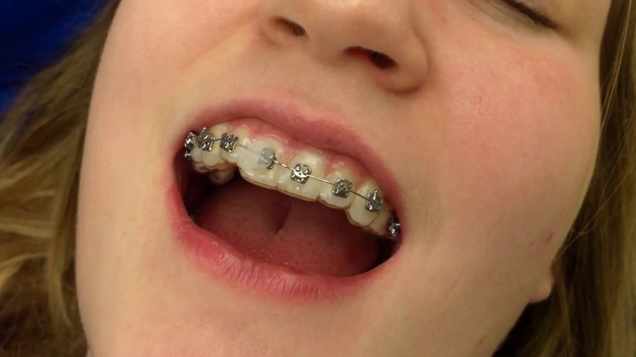 How to: Temporarily Fix a Broken Bracket on Your Braces - Banasiak & Nettune Orthodontic Associates