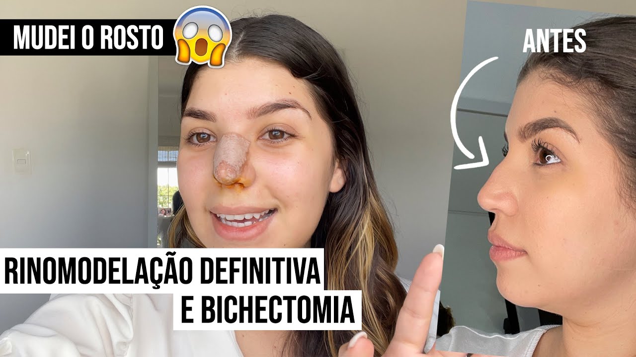 FIZ RINOMODELAÇÃO DEFINITIVA E BICHECTOMIA - como foi todo o processo | por Jessica Melo