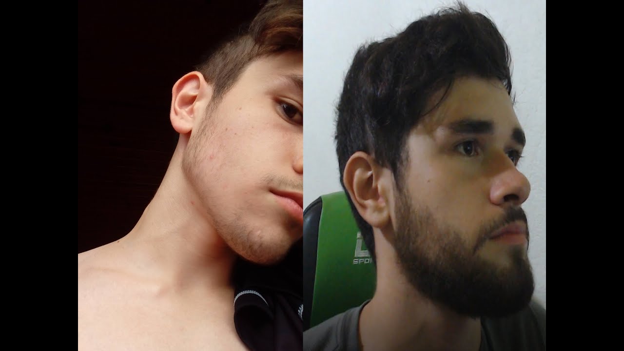 Does minoxidil work? 1 year beard evolution