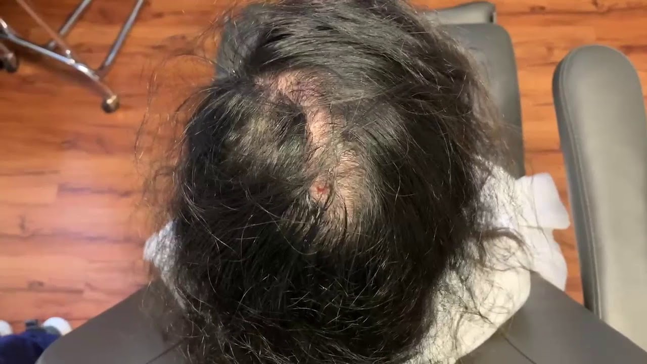 Stimulating Hair Growth with PRP Scalp
