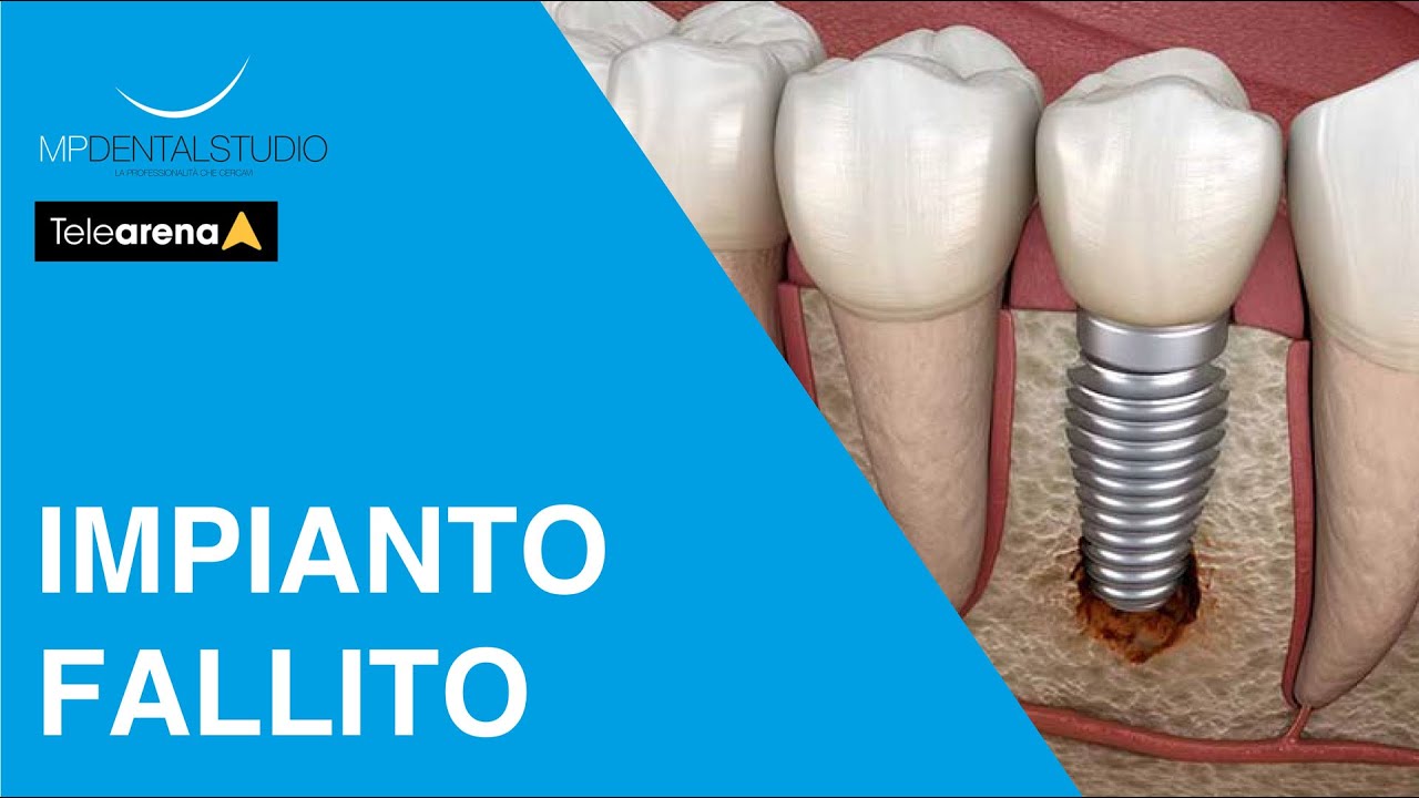 Impianto dentale fallito: le cause e cosa fare - Prof. Makarati a Dica33 - Telearena