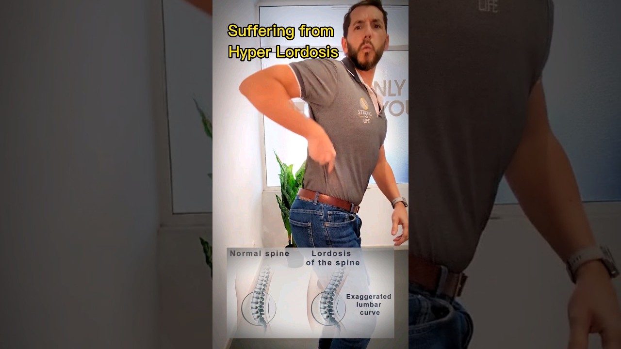 Hyperlordosis giving you pain? Try this simple exercise. #backpain #hyperlordosis #physicaltherapy