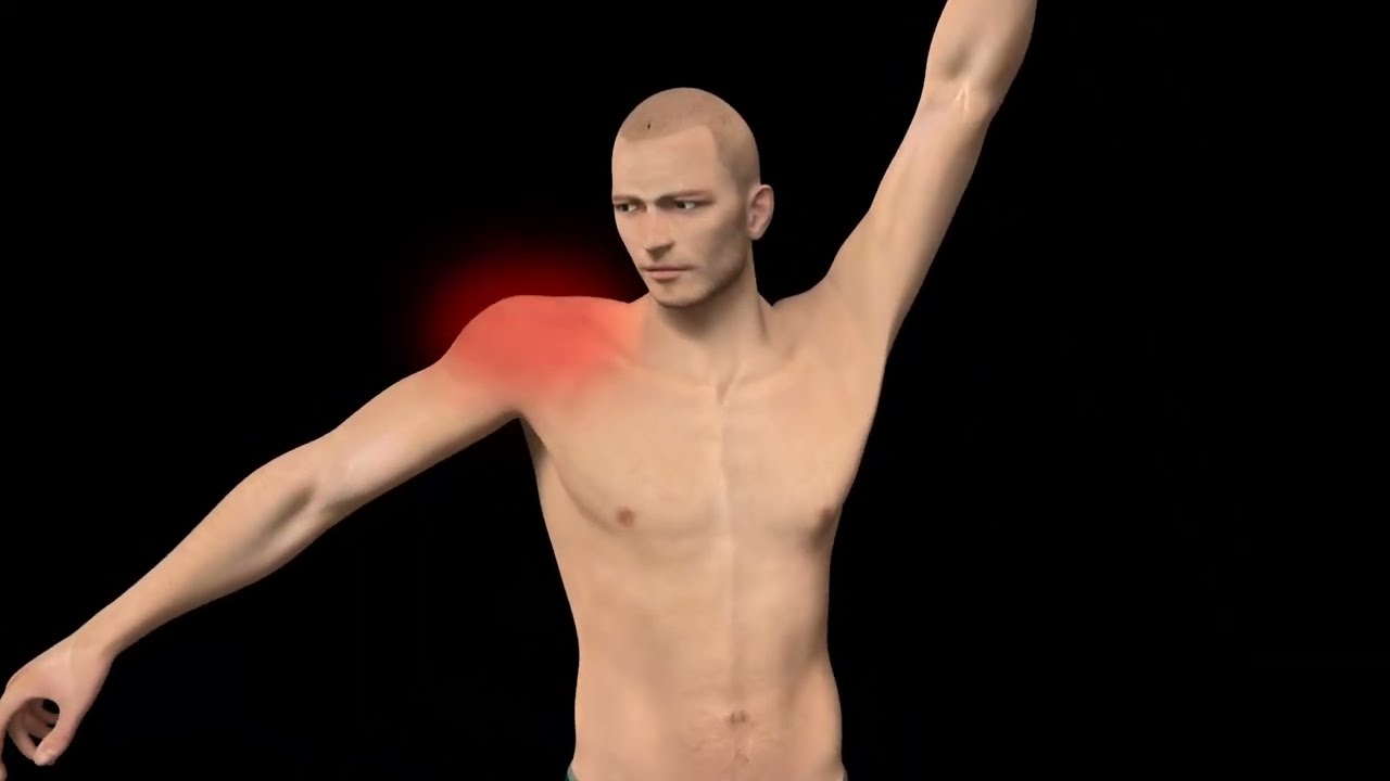 What is the best treatment for Frozen Shoulder? Adhesive Capsulitis Embolization