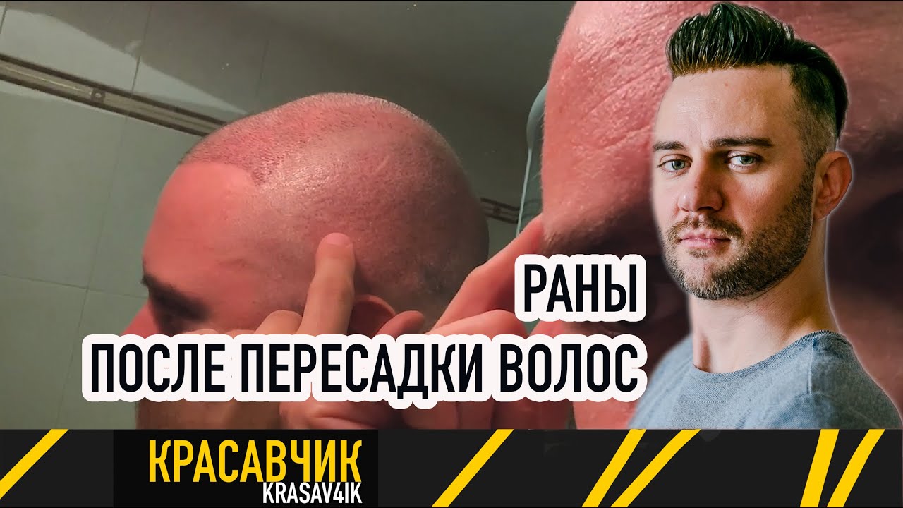 Осознание ужасной пересадки волос! Когда я понял, что клиника испортила мой внешний вид! / Красавчик