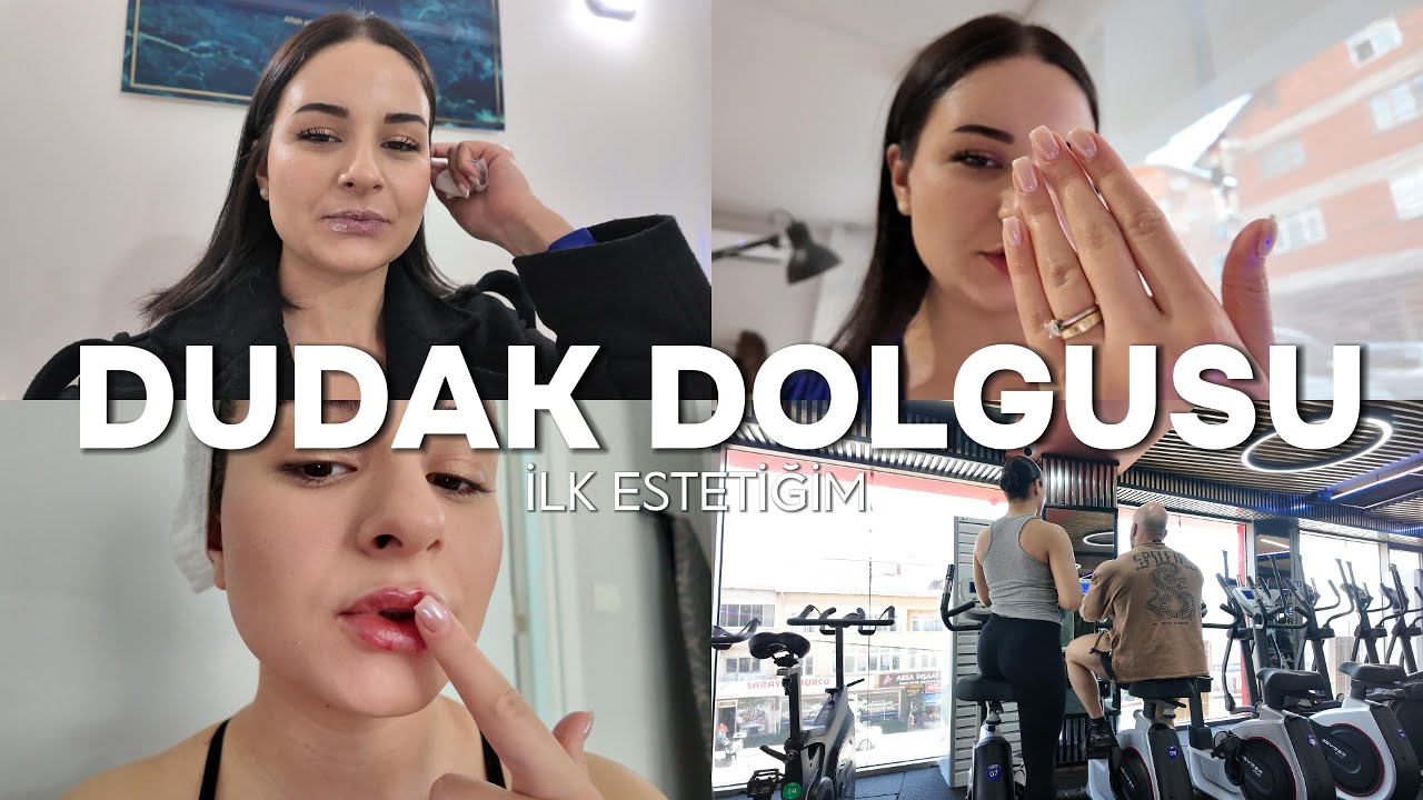 İLK ESTETİĞİM!💋 | DUDAK DOLGUSU YAPTIRDIM 💉 | EŞİMİN TEPKİSİ | GÜNDEN GÜNE İYİLEŞME SÜRECİ | VLOG