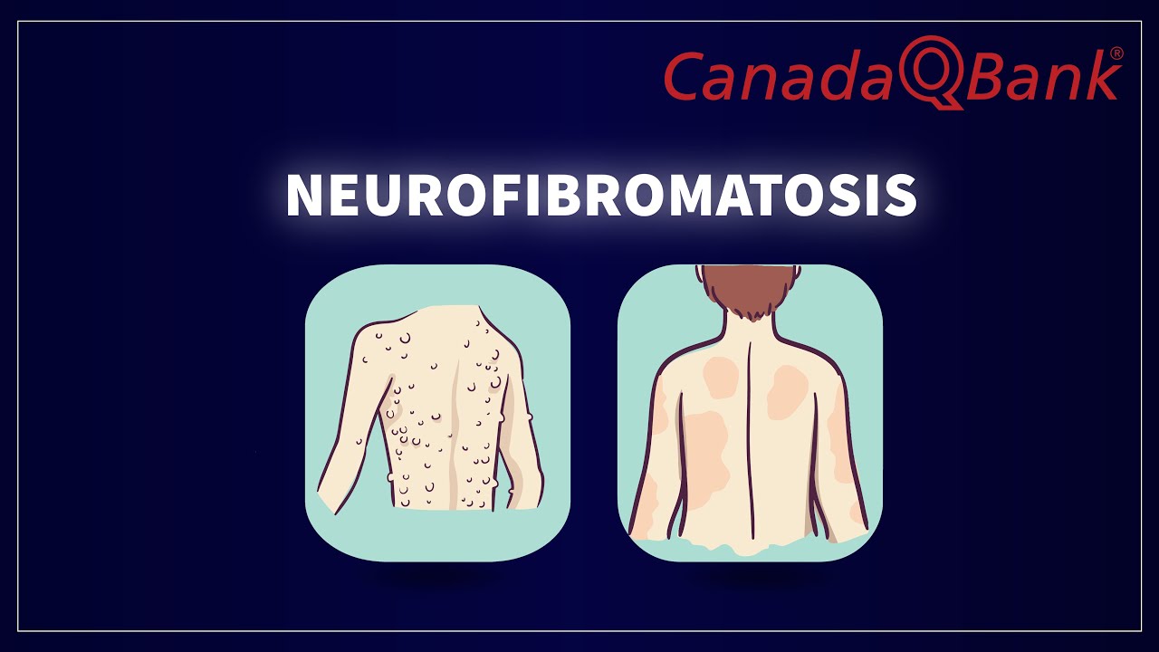 Neurofibromatosis Type 1 & 2: Symptoms, Diagnosis & Management | High-Yield Clinical Review