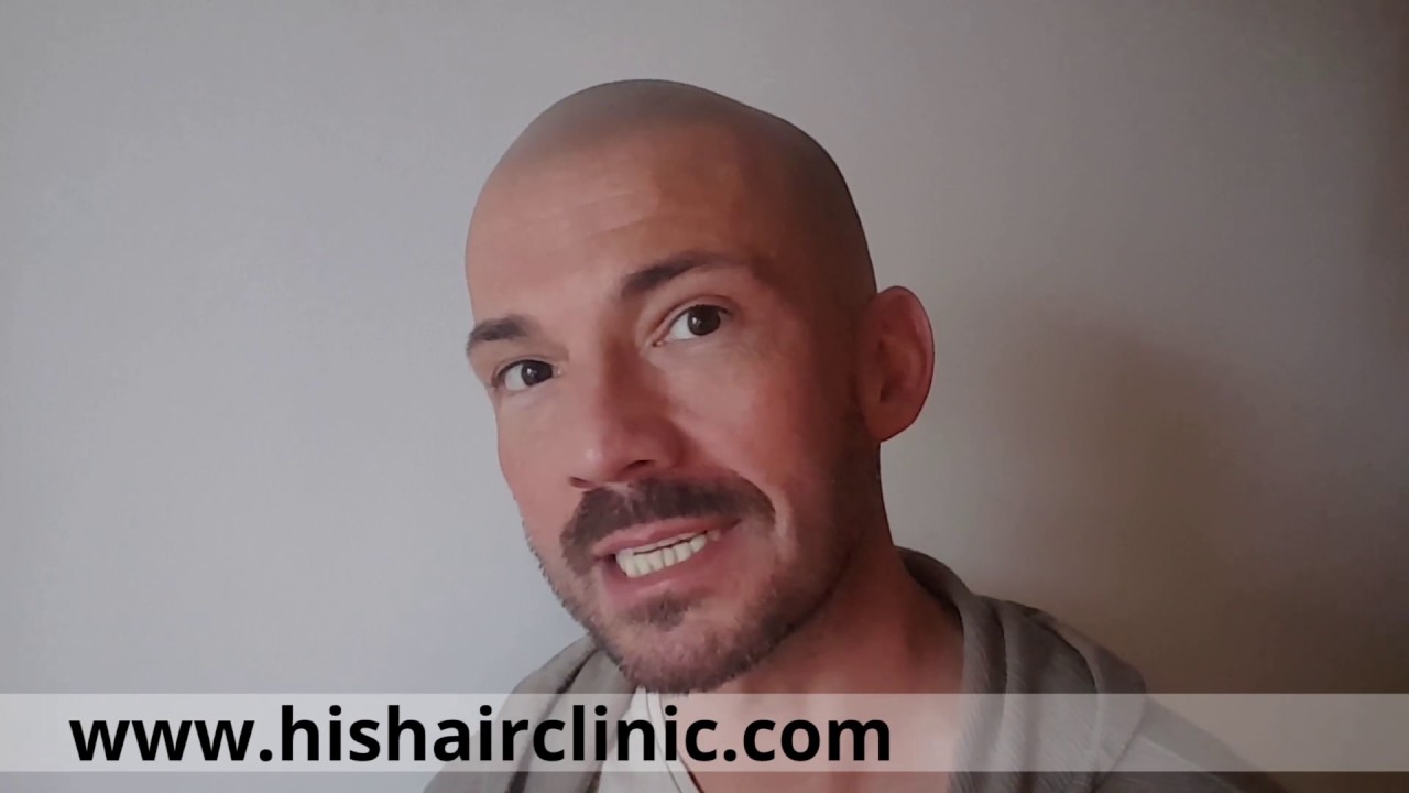 Karl’s Scalp Micropigmentation Review - HIS Hair Clinic for Hair Loss