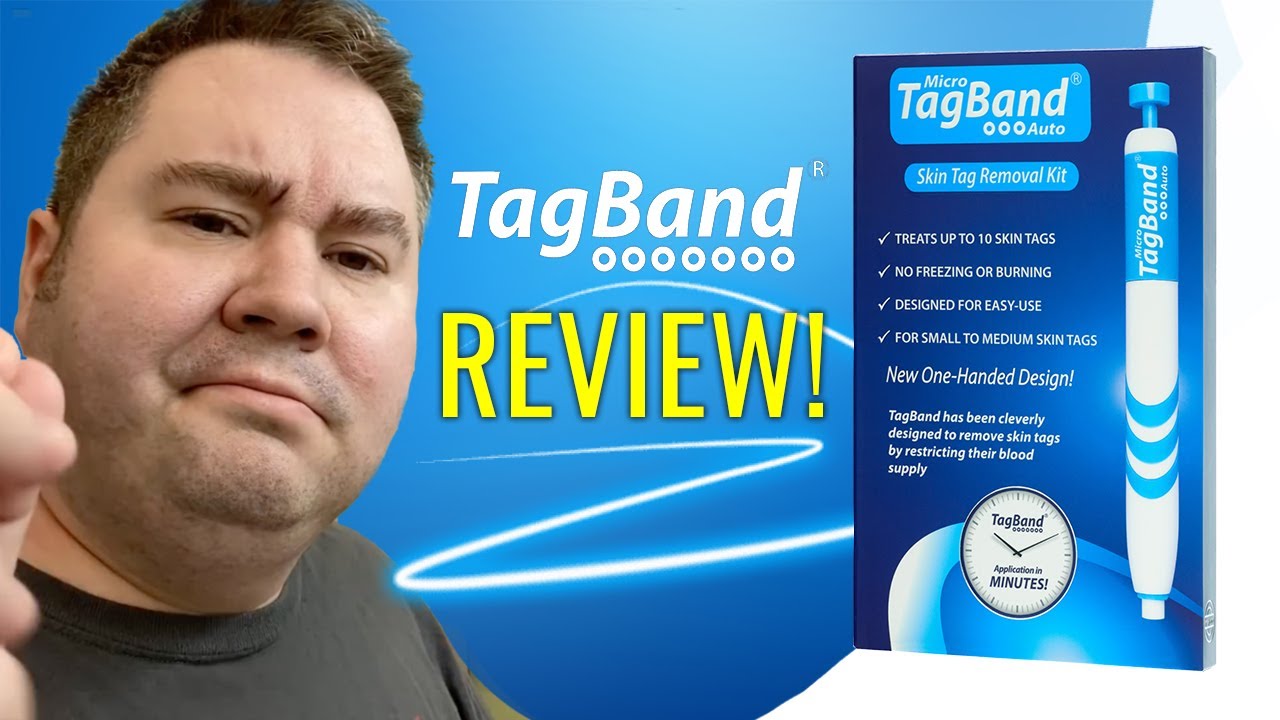 HOW TO REMOVE SKIN TAGS | Does TagBand Work? TagBand Review!
