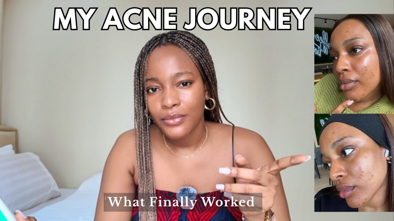 How I Manage Acne: My Skincare Routine + Best products that work!