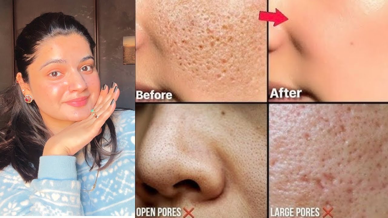 How To Get Rid Of OPEN PORES Naturally at Home | Minimise Pores and Get Glowing Skin