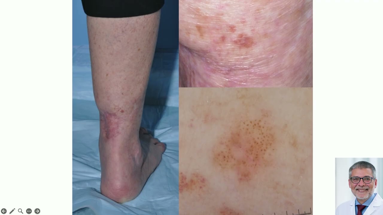 (Part 1 of 2) Dermoscopy Primer - Ashfaq Marghoob, MD