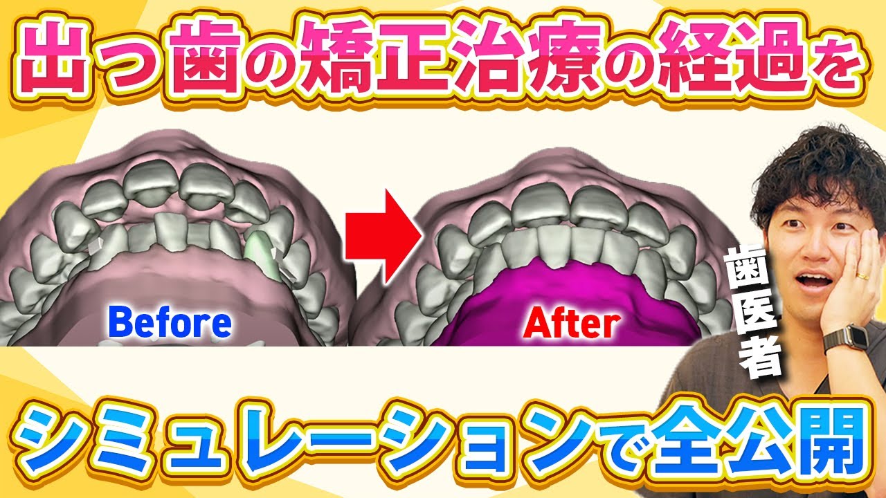 出っ歯を最短で綺麗に治す！シュアスマイル矯正シミュレーション解説【歯列矯正/マウスピース矯正】