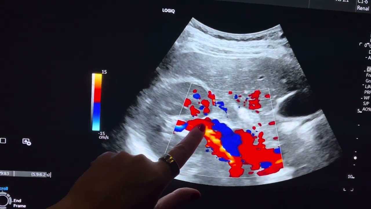 Ultrasound renal artery stenosis