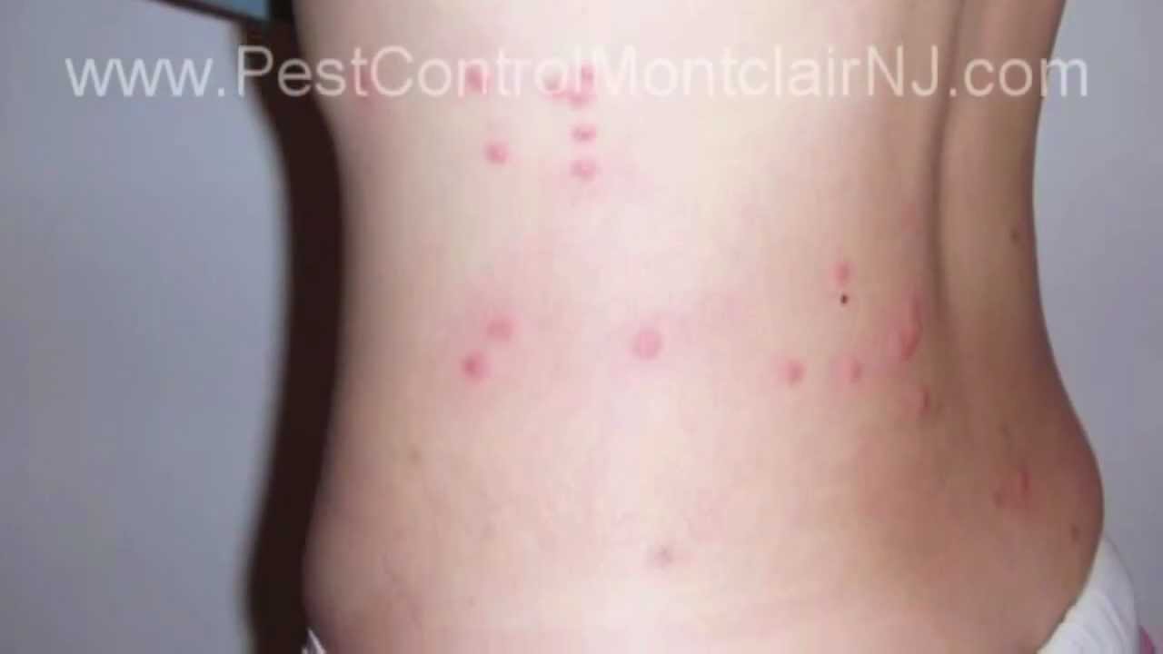 Pest Control: Bed Bug Montclair NJ