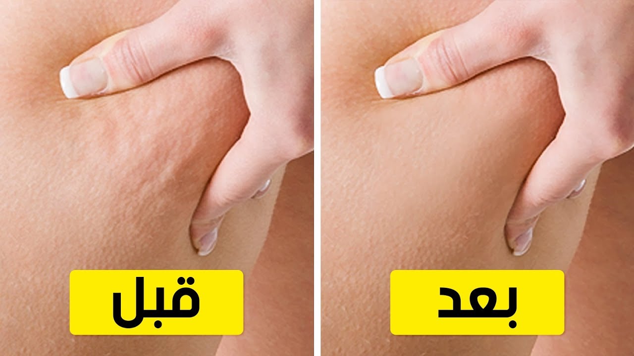 6 تمارين للتخلص من السيلوليت في أسبوعين