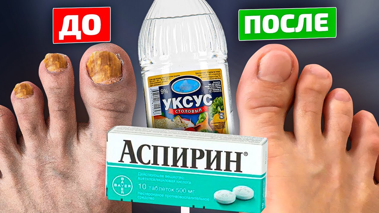 Тайное оружие фармацевтов от грибка ногтей! Уксус и аспирин
