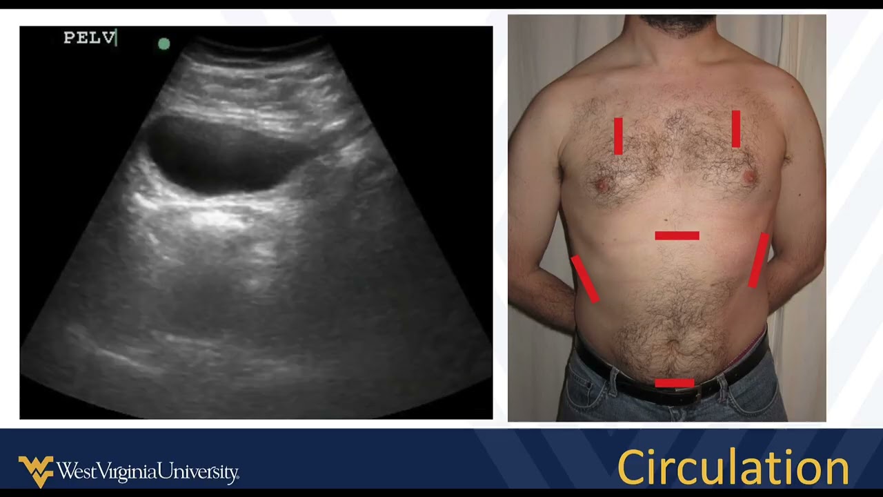 M3 POCUS Cases Surgery Trauma FAST