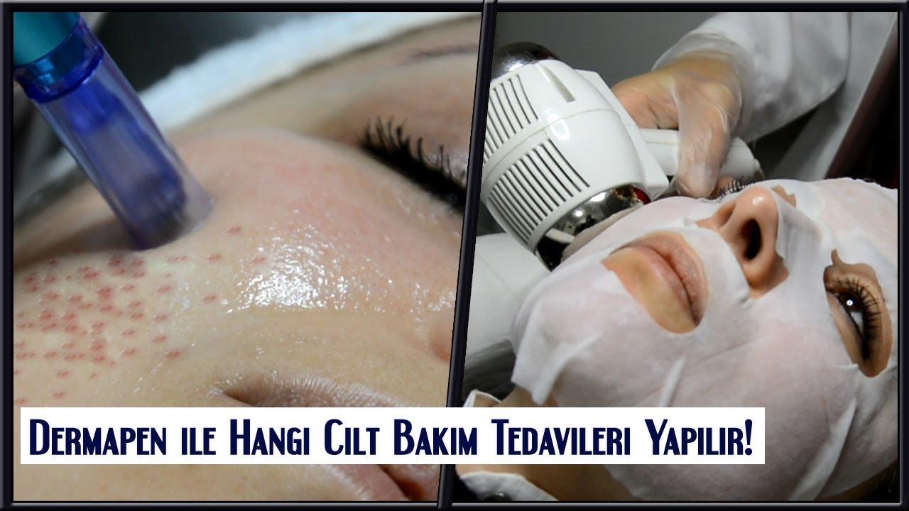 Dermapen Uygulaması Nedir ve Nasıl Yapılır? | Dermapen Mikro İğneleme Yöntemi ile Cilt Tedavisi!