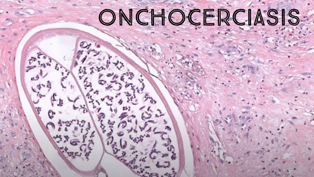 Onchocerciasis (Onchocercoma - tangled mass of Onchocerca worms w paired uterus & microfilaria)