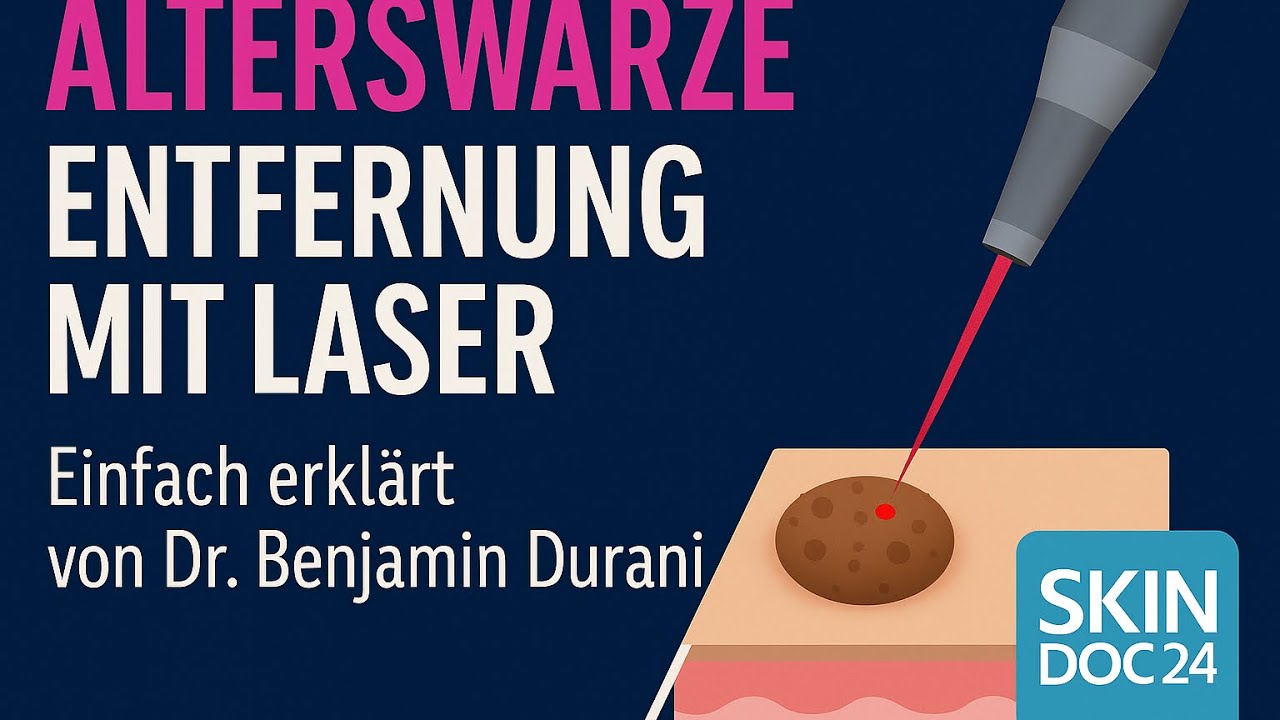 Alterswarze &ndash; Entfernung mit CO₂-Laser.  Einfach erkl&auml;rt von Dr. Benjamin Durani