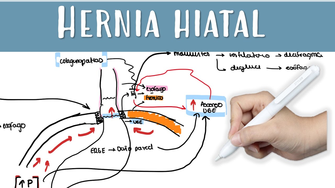 HERNIA HIATAL #RGE #funduplicatura #nissen # paraesofagica